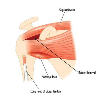 Inflamed Rotator Cuff from Basketball